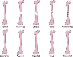 Type of bone fracture