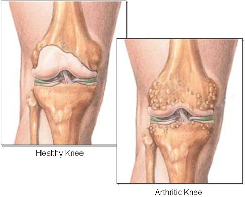 Seek professional advises about your knee pain: