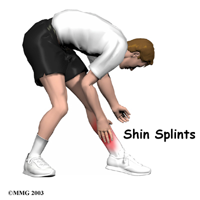 Shin Splint