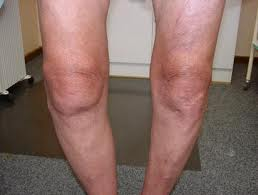 Osteoarthritis Bilateral Knees