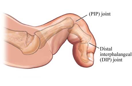 Claw Toe Deformity