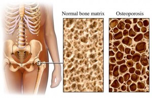 Osteoporosis and Normal Bone Matrix
