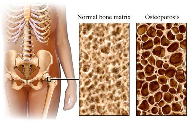 Osteoporosis vs Normal Bone