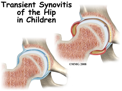 Hip Synovitis in Children