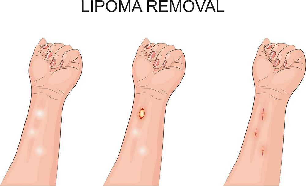 lipoma removal