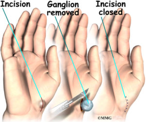 ganglion cyst removal