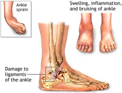 ankle sprain clinic