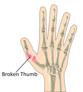 thumb fracture