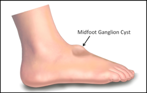 Midfoot ganglion cyst