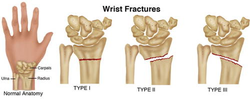 Wrist Fracture Clinic