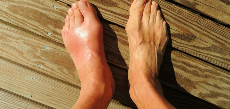 Foot Pain Gout
